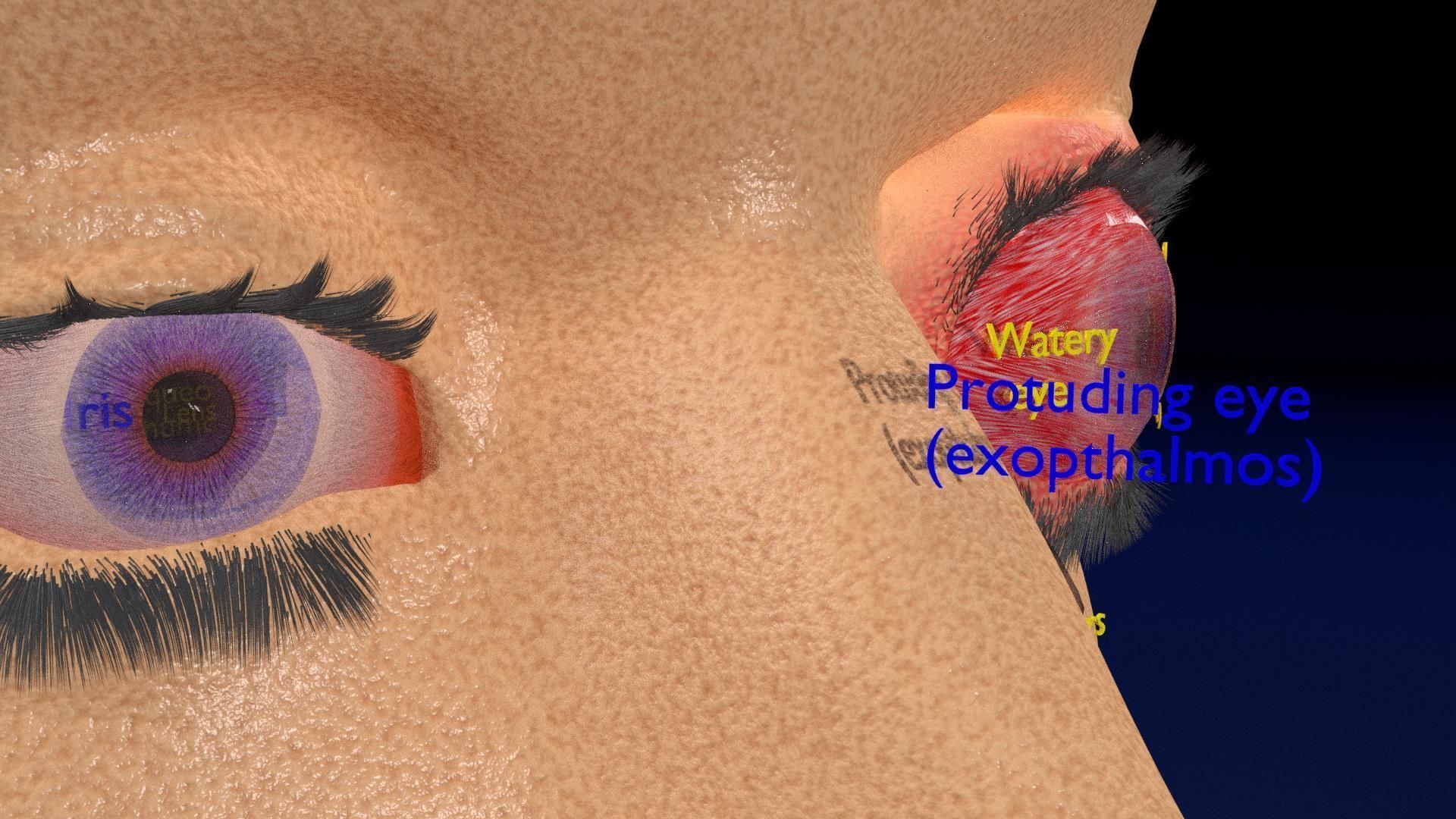 Thyroid eye lesions 3D model_4