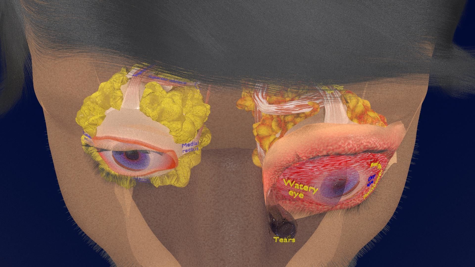 Thyroid eye lesions 3D model_14