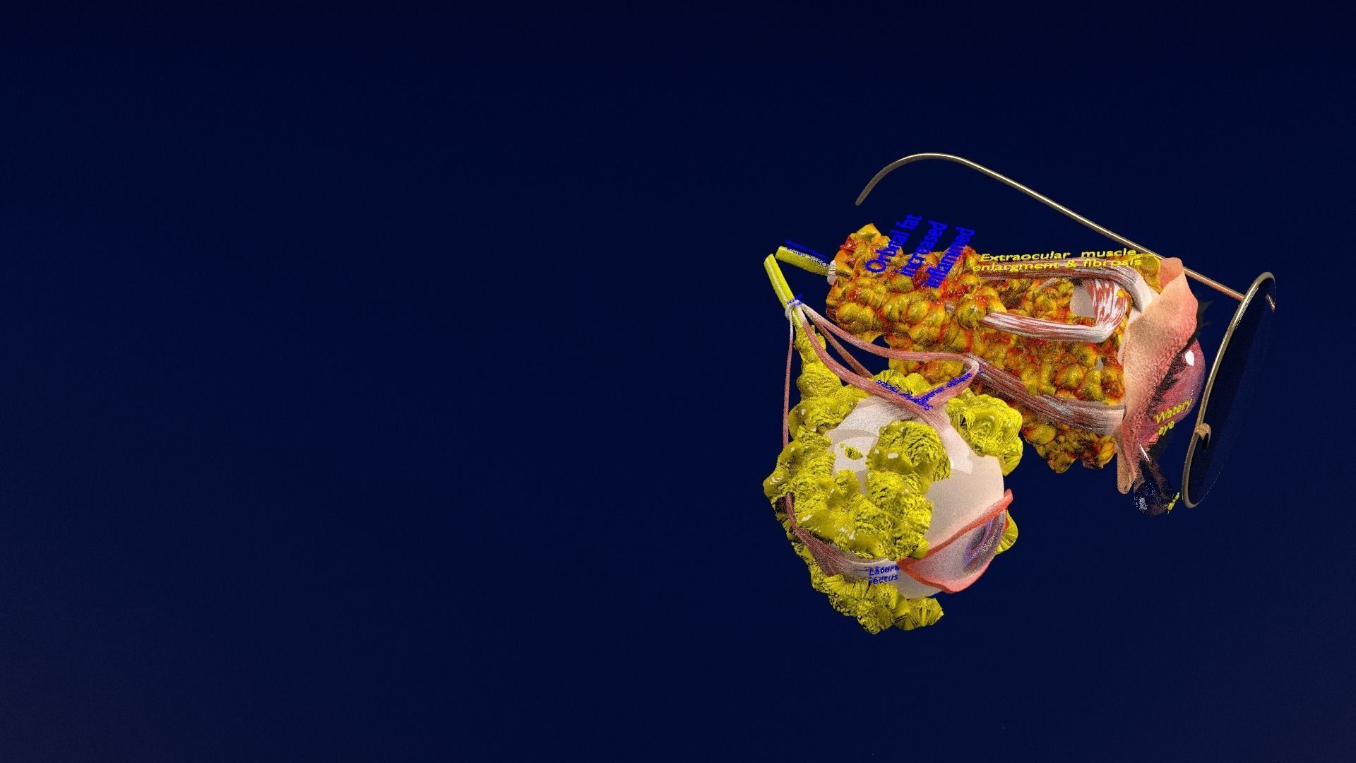 Thyroid eye lesions 3D model_58