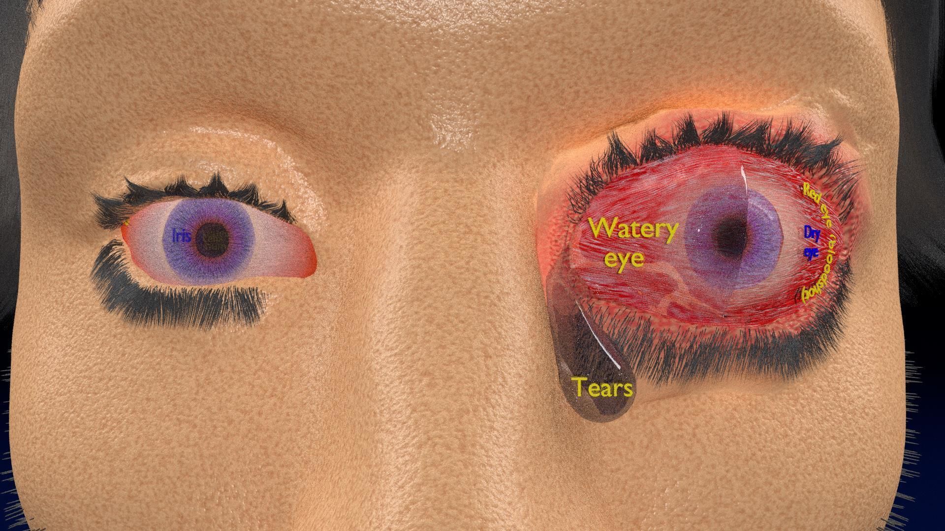 Thyroid eye lesions 3D model_13
