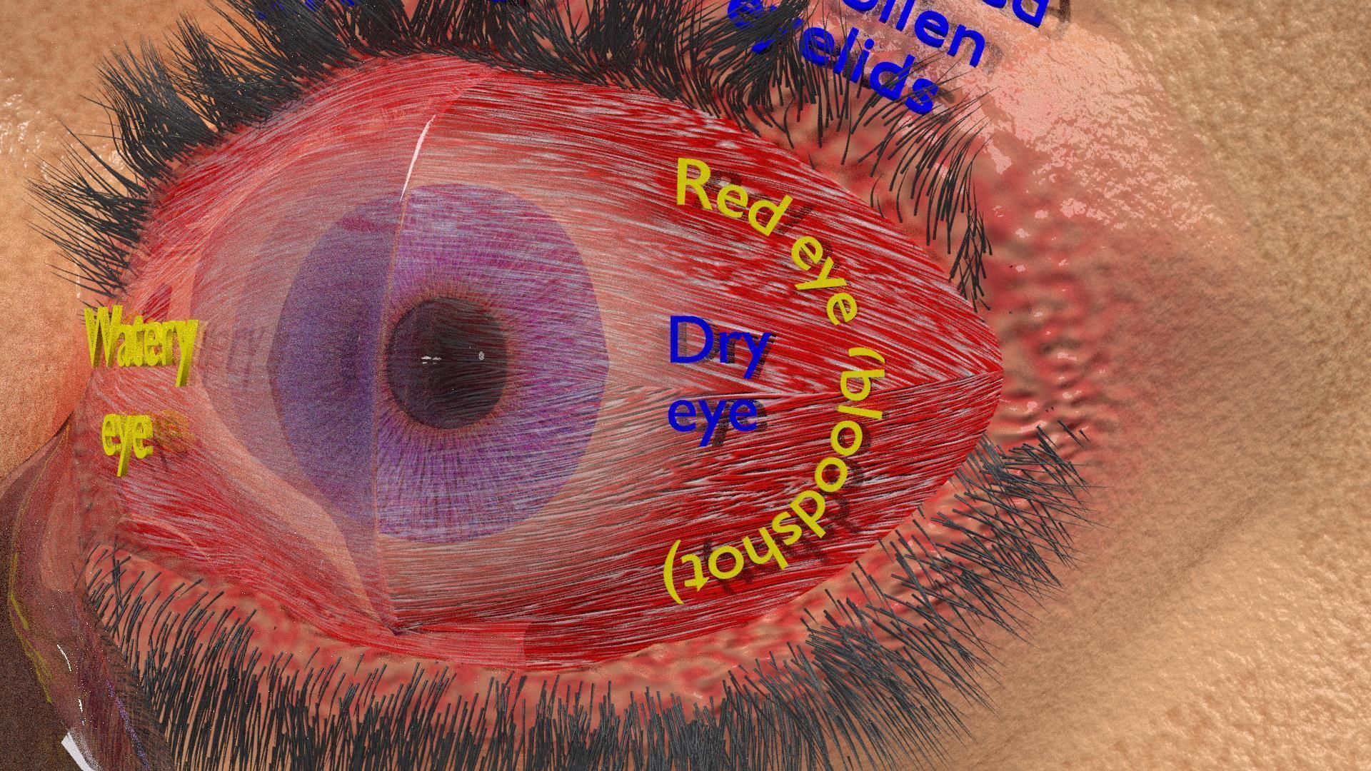 Thyroid eye lesions 3D model_11