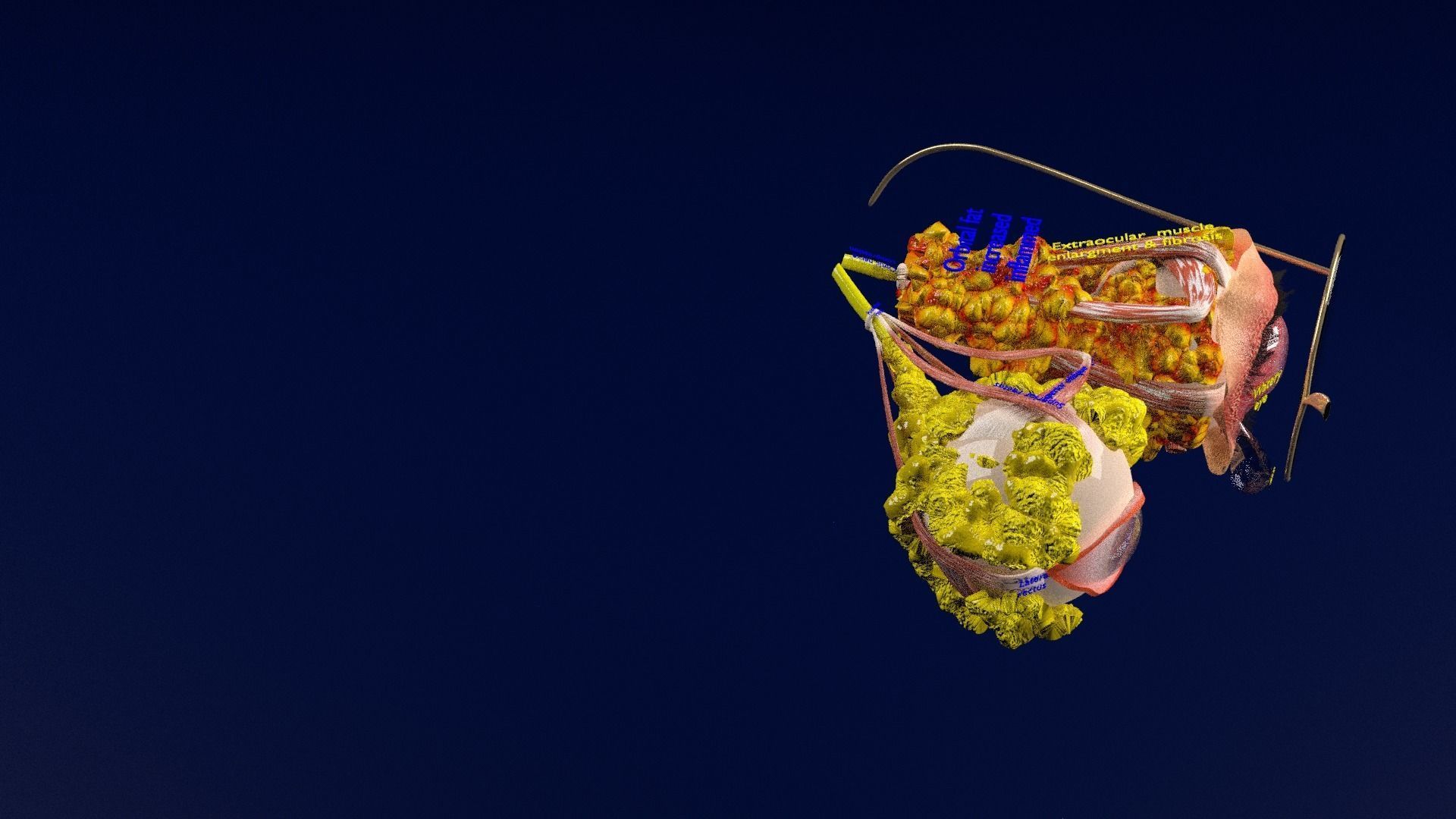 Thyroid eye lesions 3D model_45