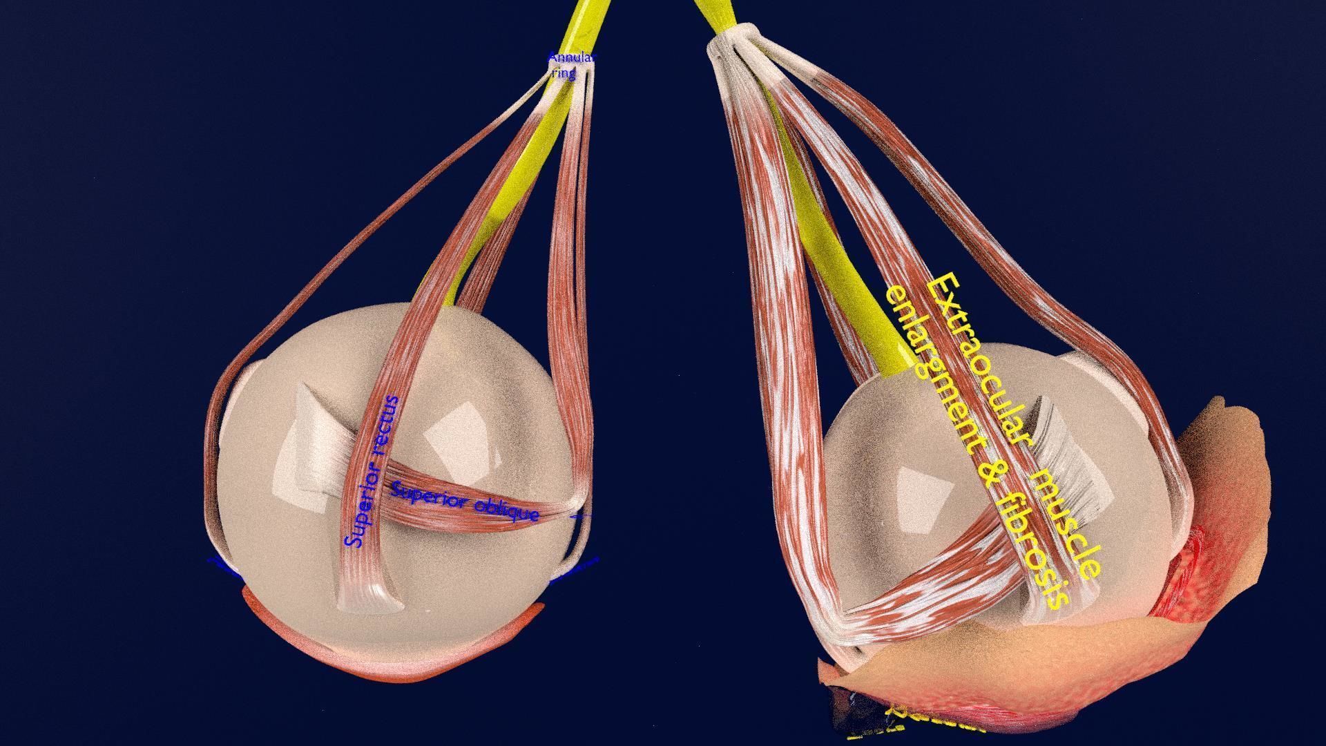 Thyroid eye lesions 3D model_17