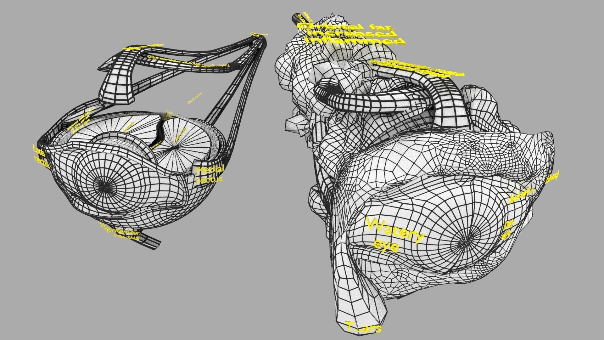 Thyroid eye lesions 3D model_26