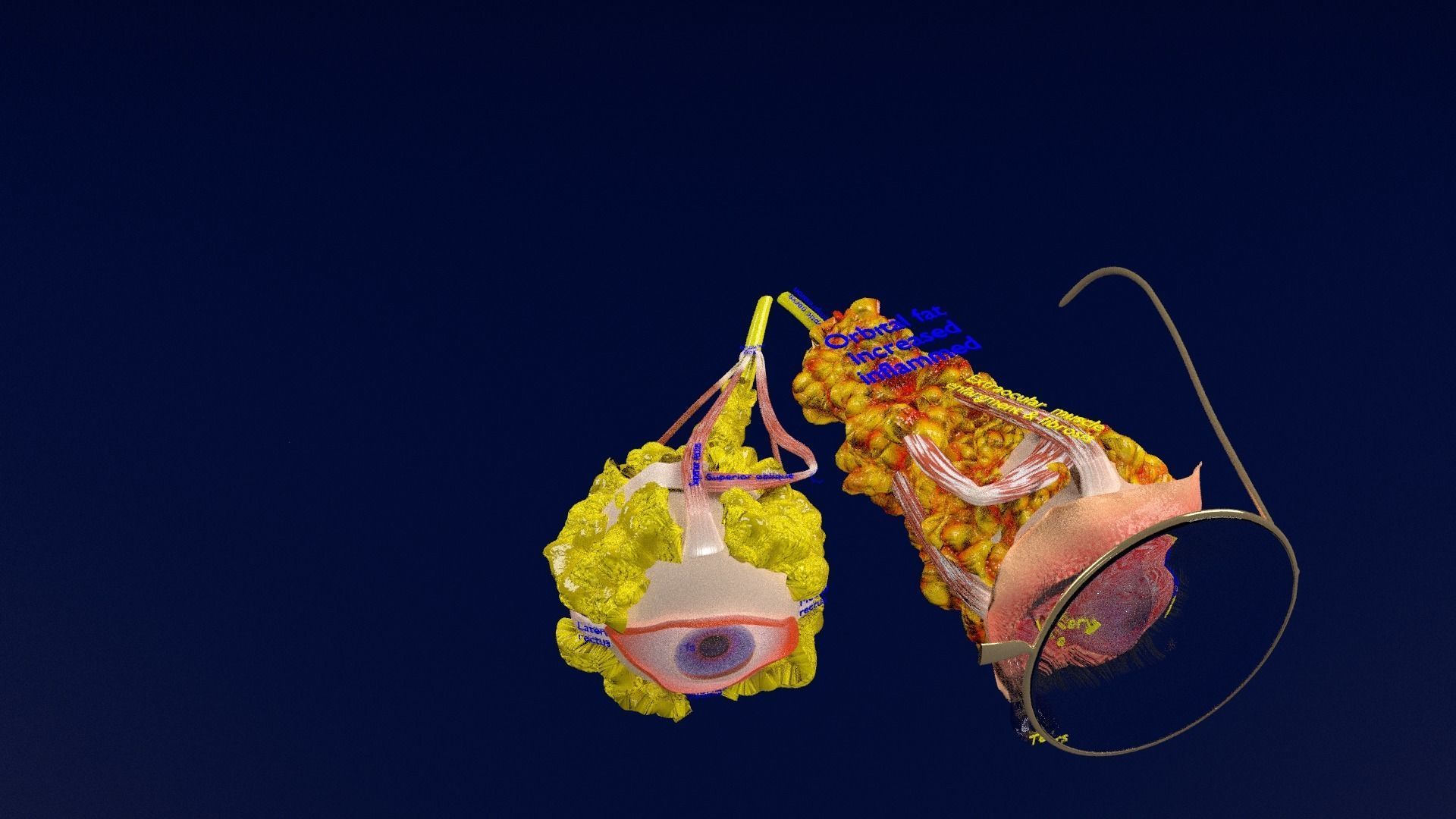 Thyroid eye lesions 3D model_43