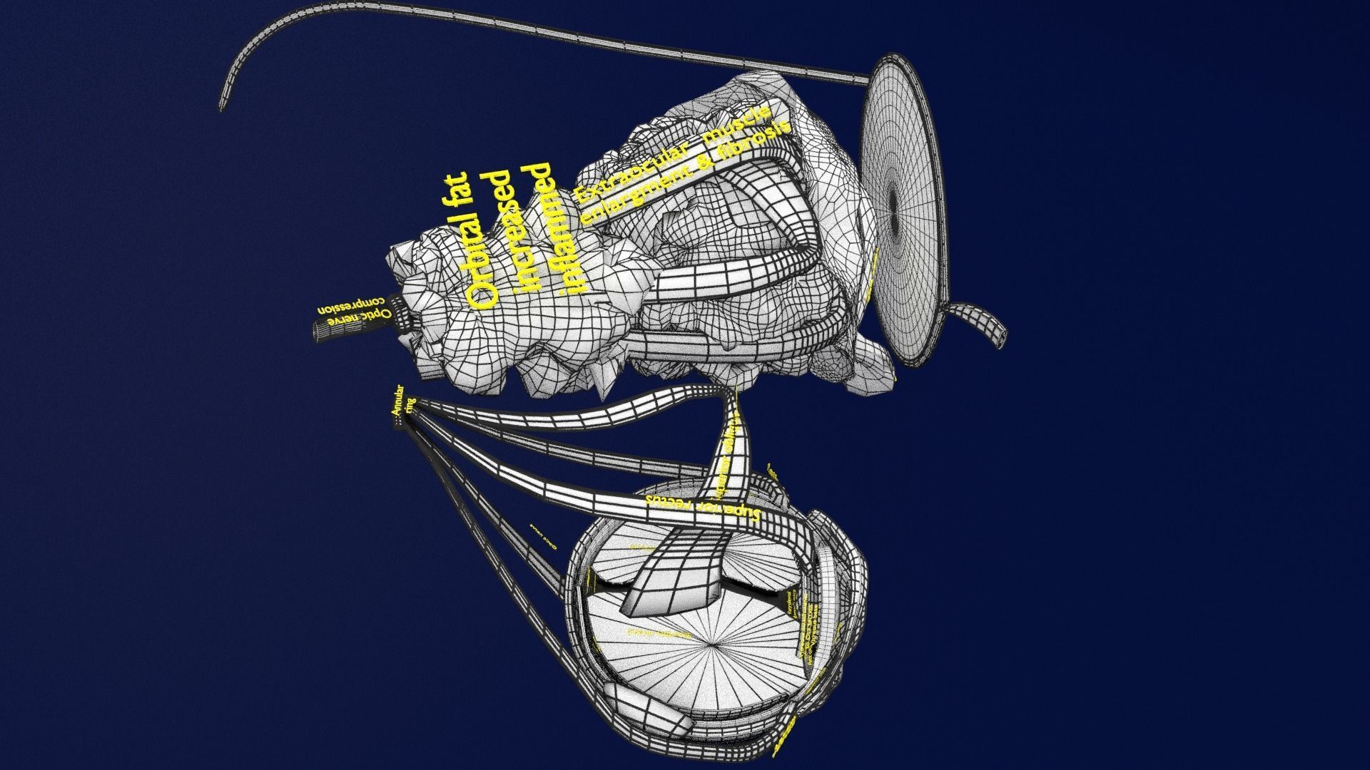 Thyroid eye lesions 3D model_24
