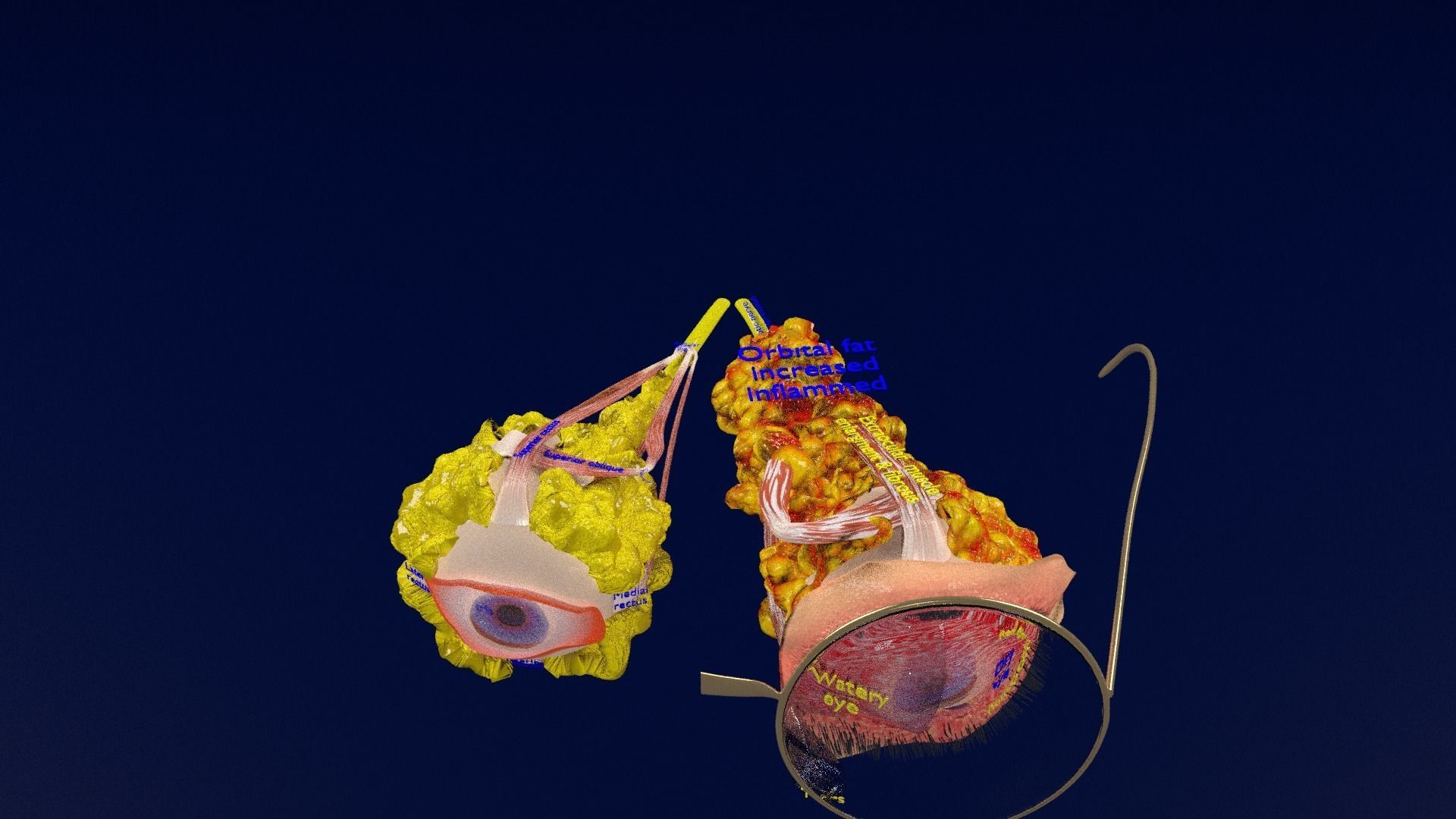 Thyroid eye lesions 3D model_51