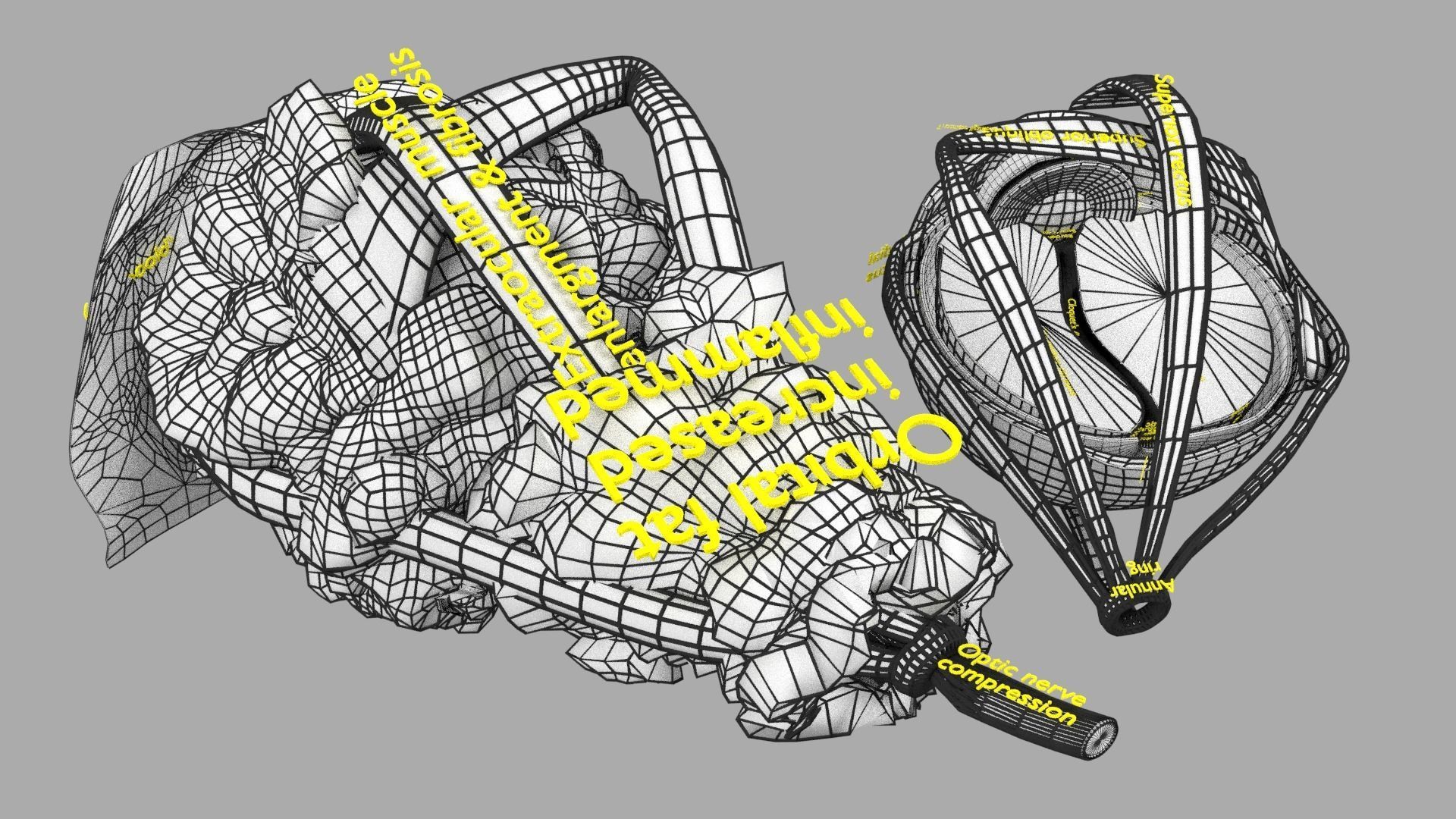 Thyroid eye lesions 3D model_27
