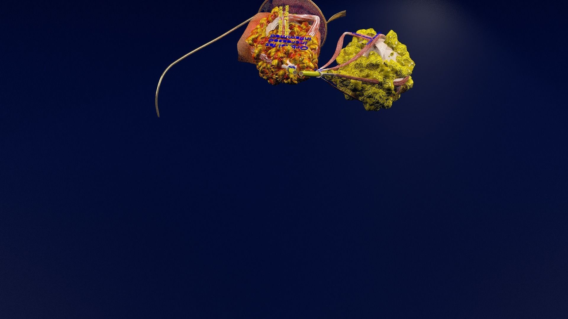 Thyroid eye lesions 3D model_71