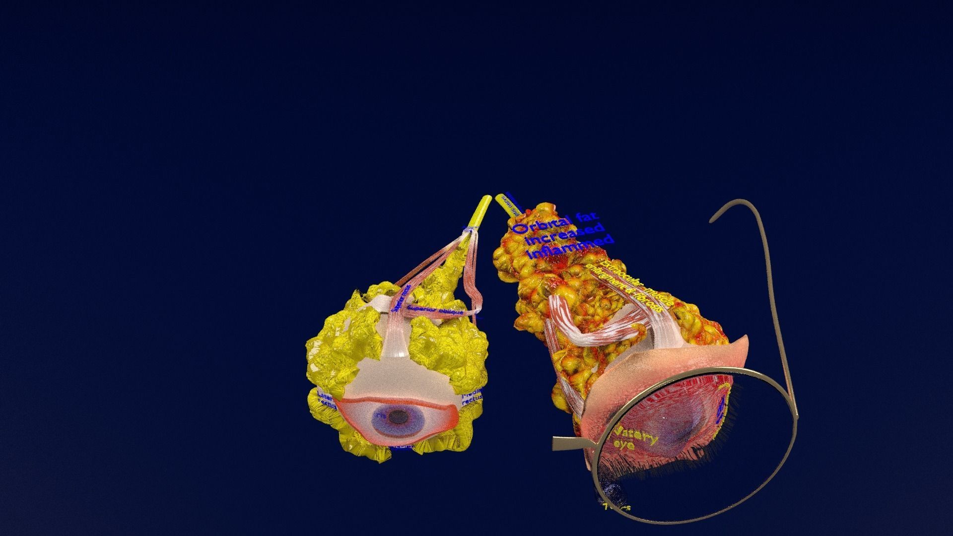 Thyroid eye lesions 3D model_44