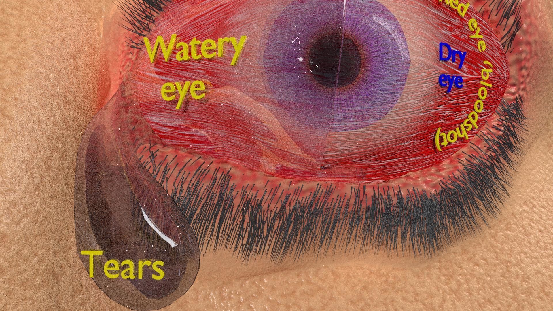 Thyroid eye lesions 3D model_12