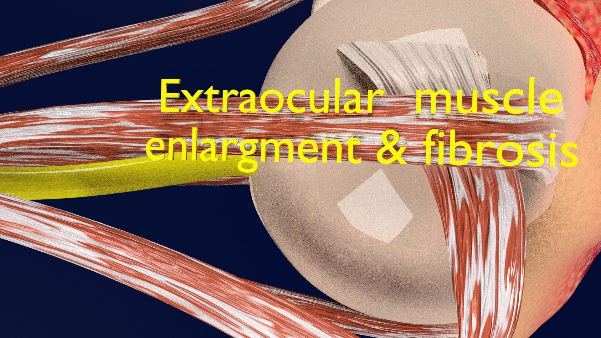 Thyroid eye lesions 3D model_18