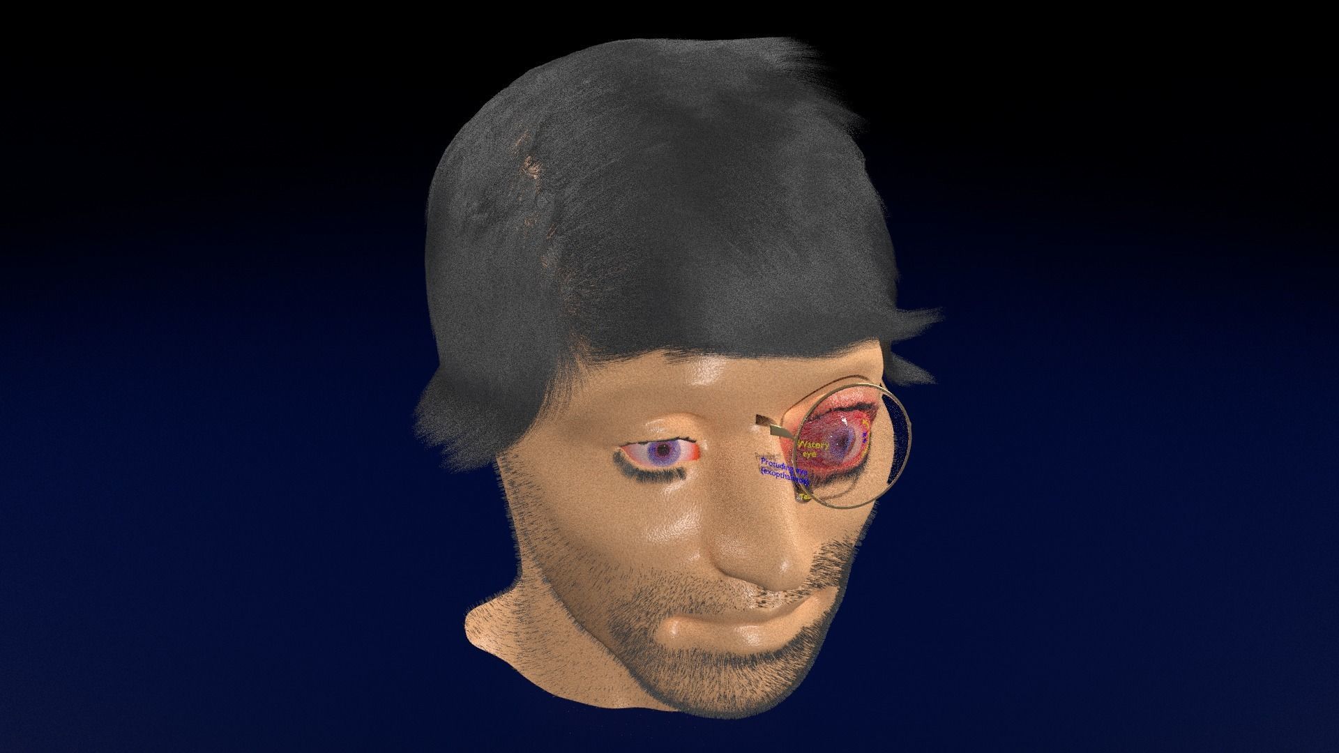 Thyroid eye lesions 3D model_87