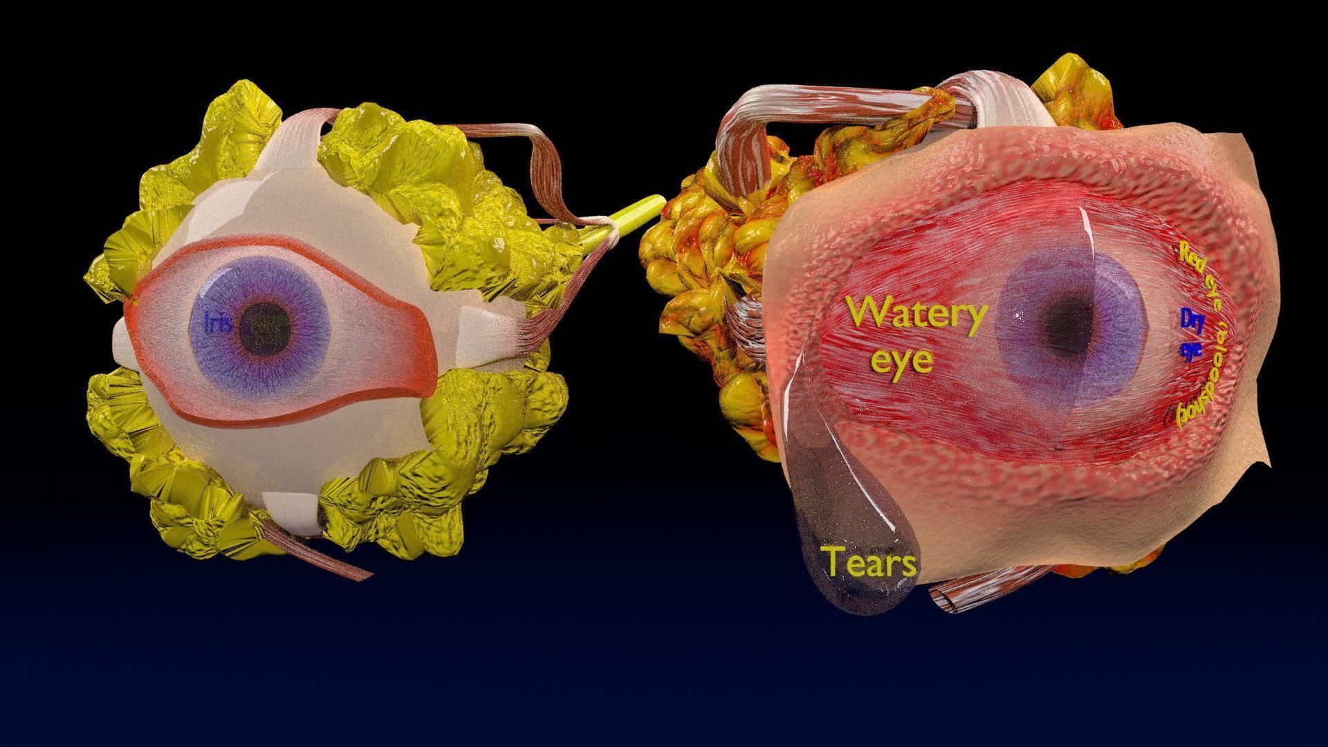 Thyroid eye lesions 3D model_20