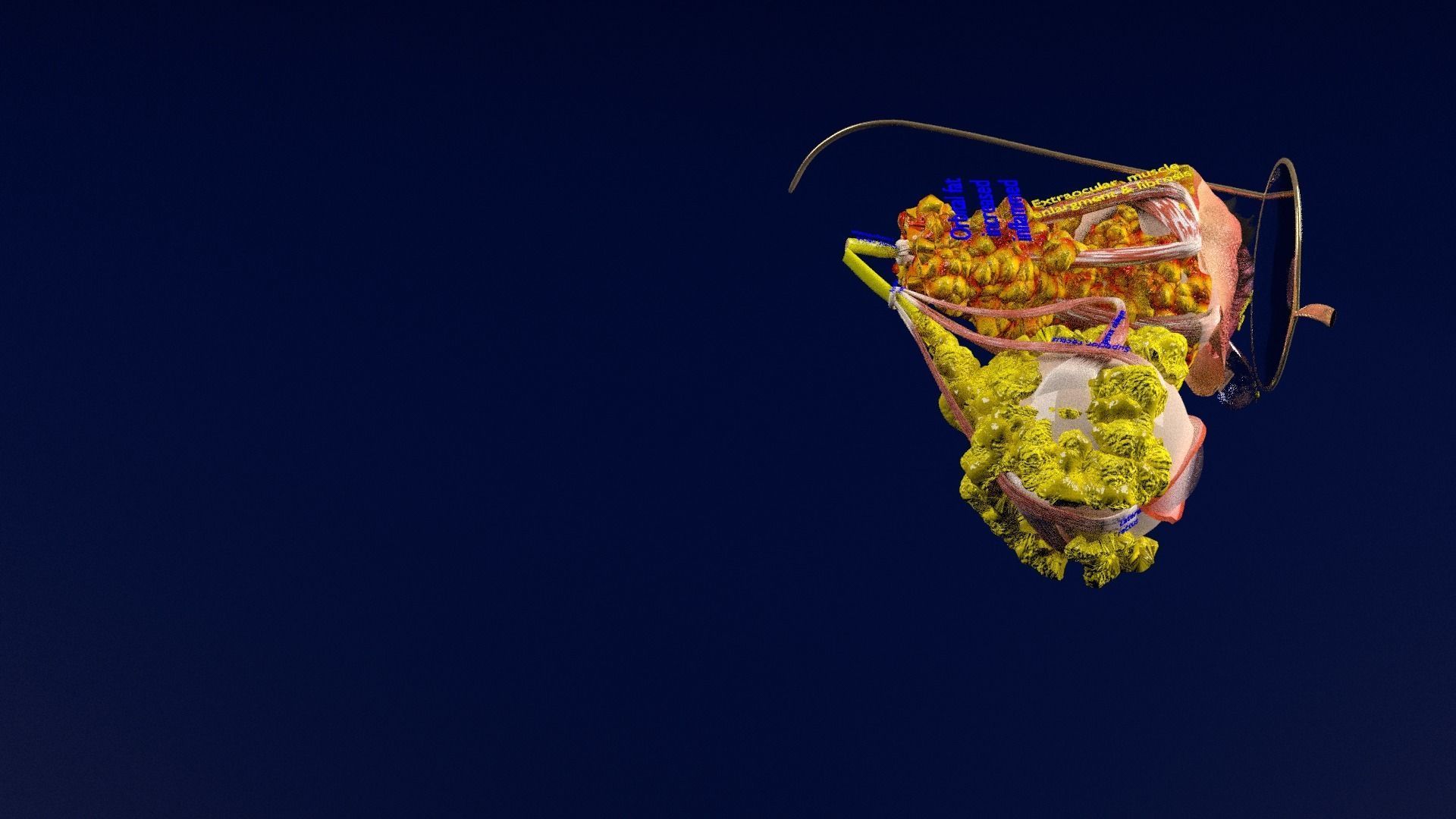 Thyroid eye lesions 3D model_47