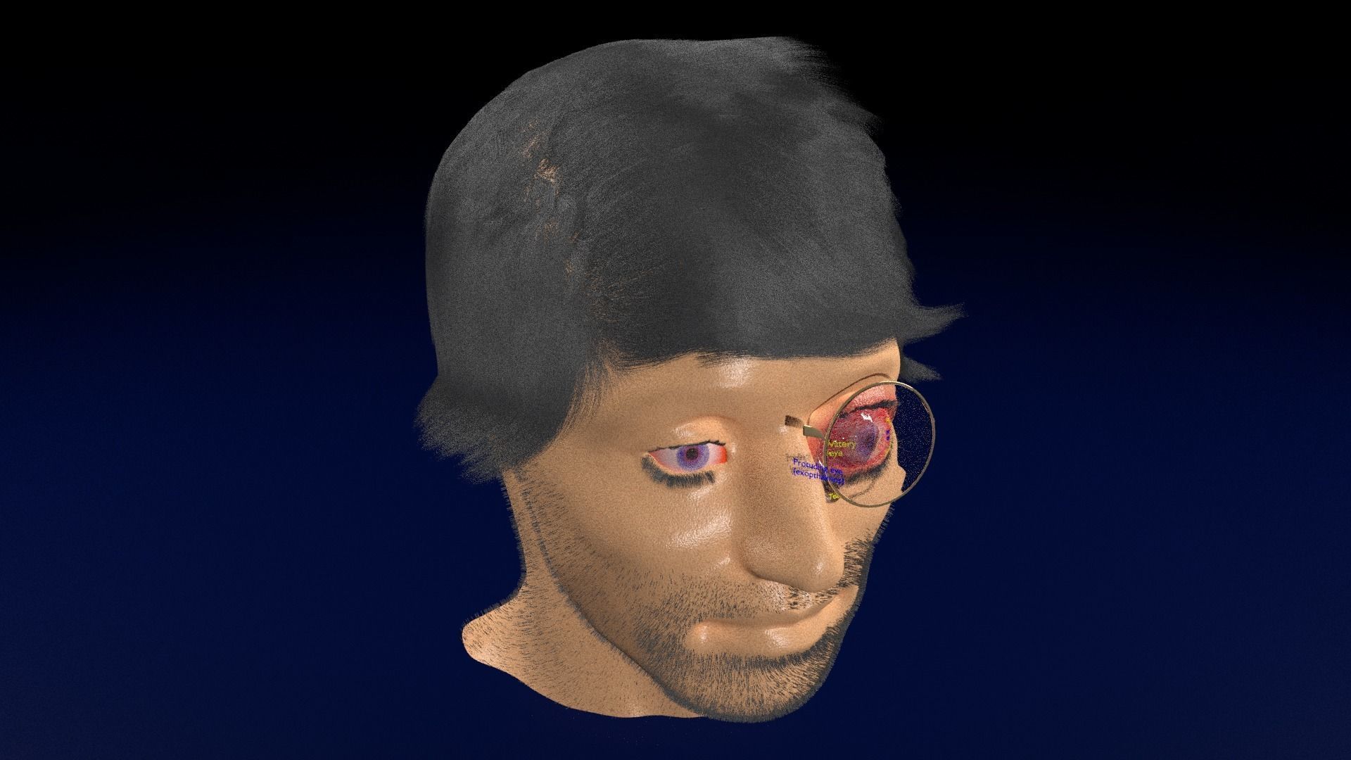 Thyroid eye lesions 3D model_90