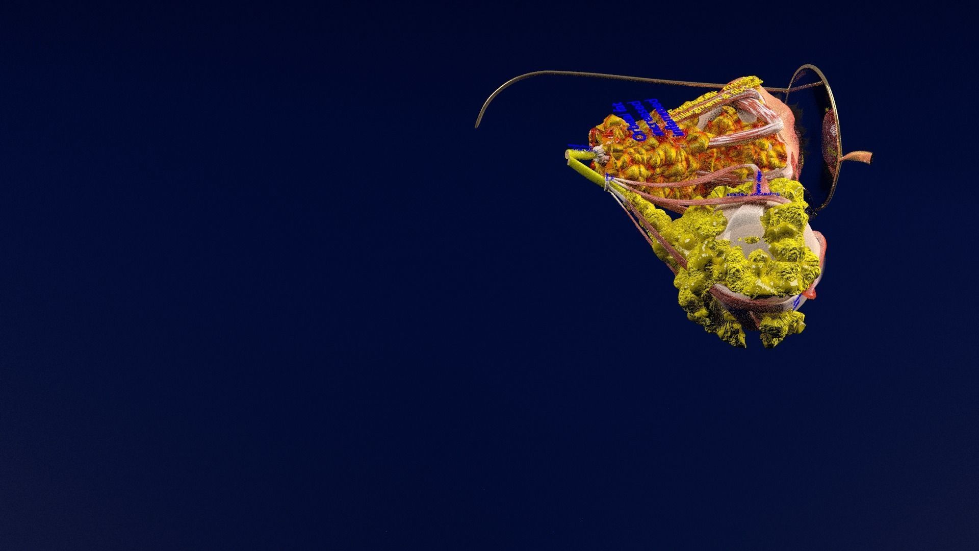 Thyroid eye lesions 3D model_48