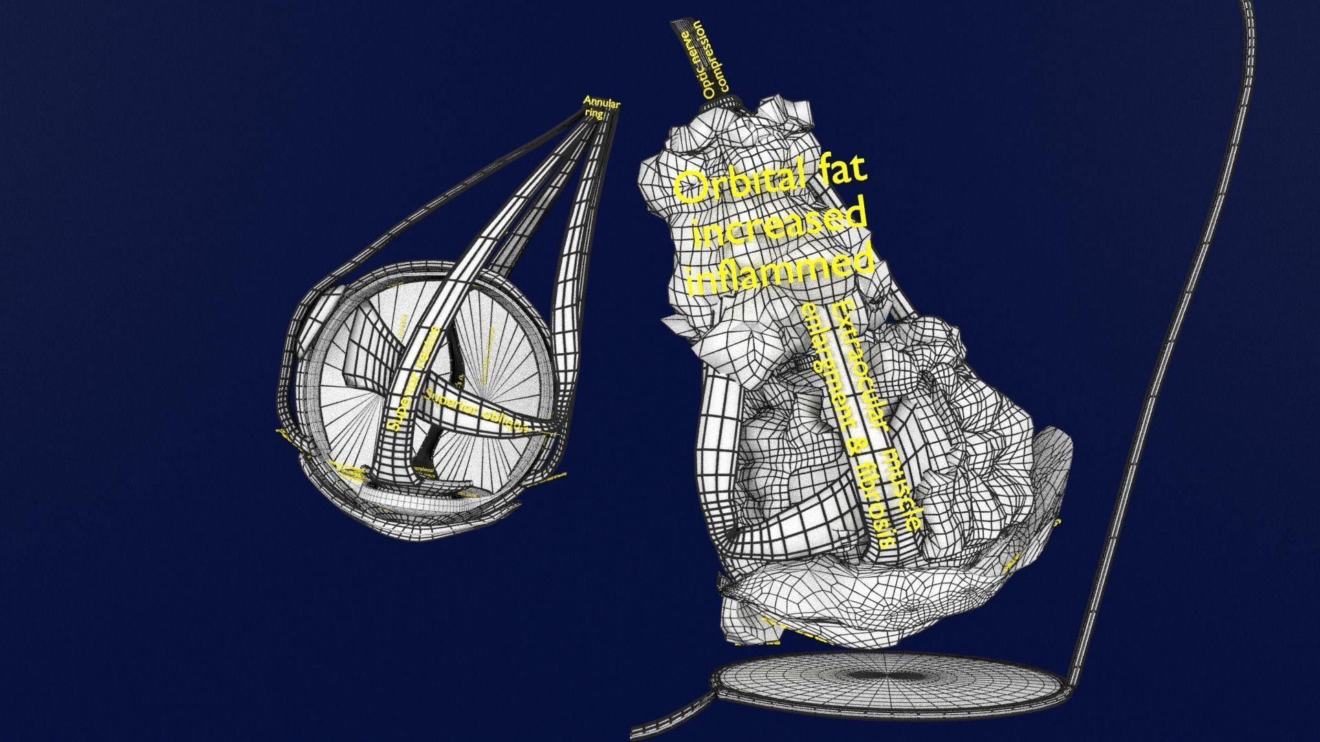 Thyroid eye lesions 3D model_23