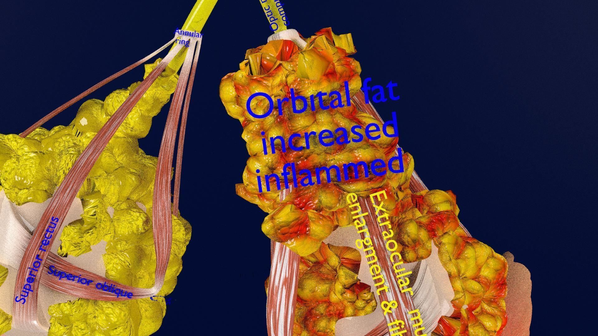 Thyroid eye lesions 3D model_15