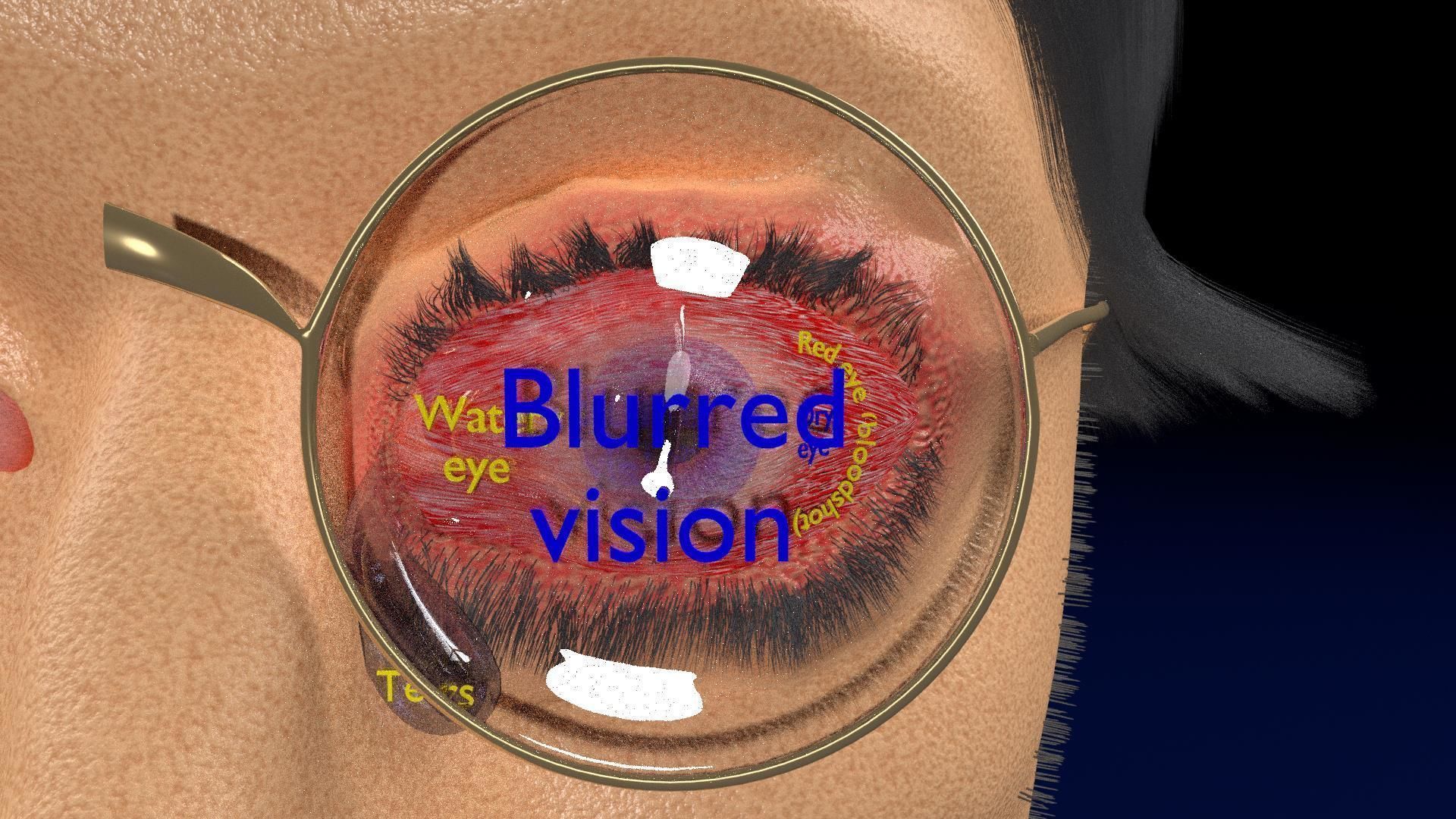 Thyroid eye lesions 3D model_5