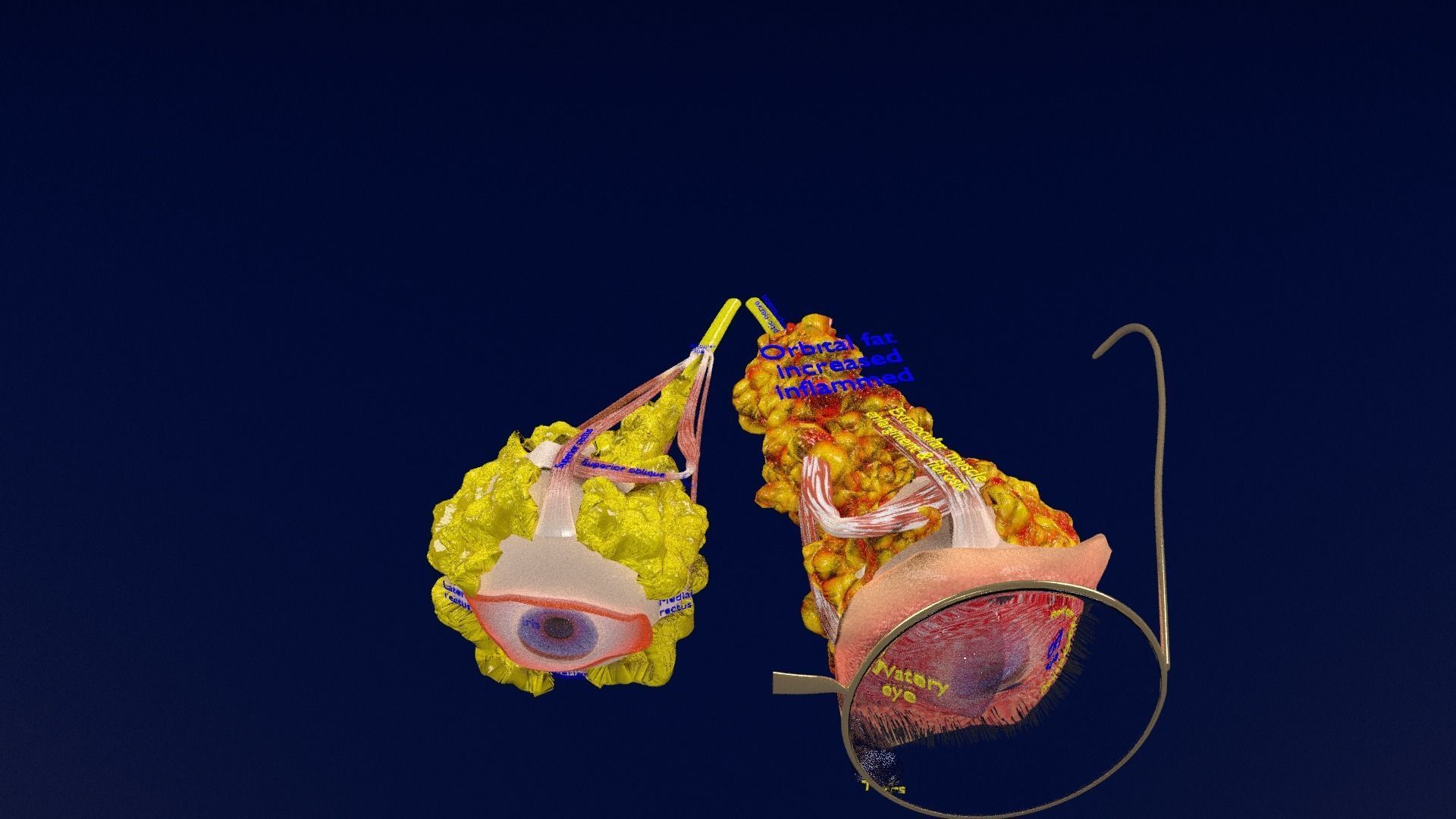 Thyroid eye lesions 3D model_39