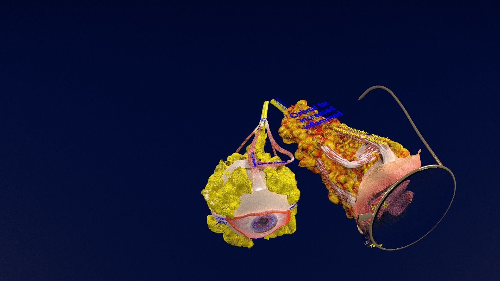 Thyroid eye lesions 3D model_53