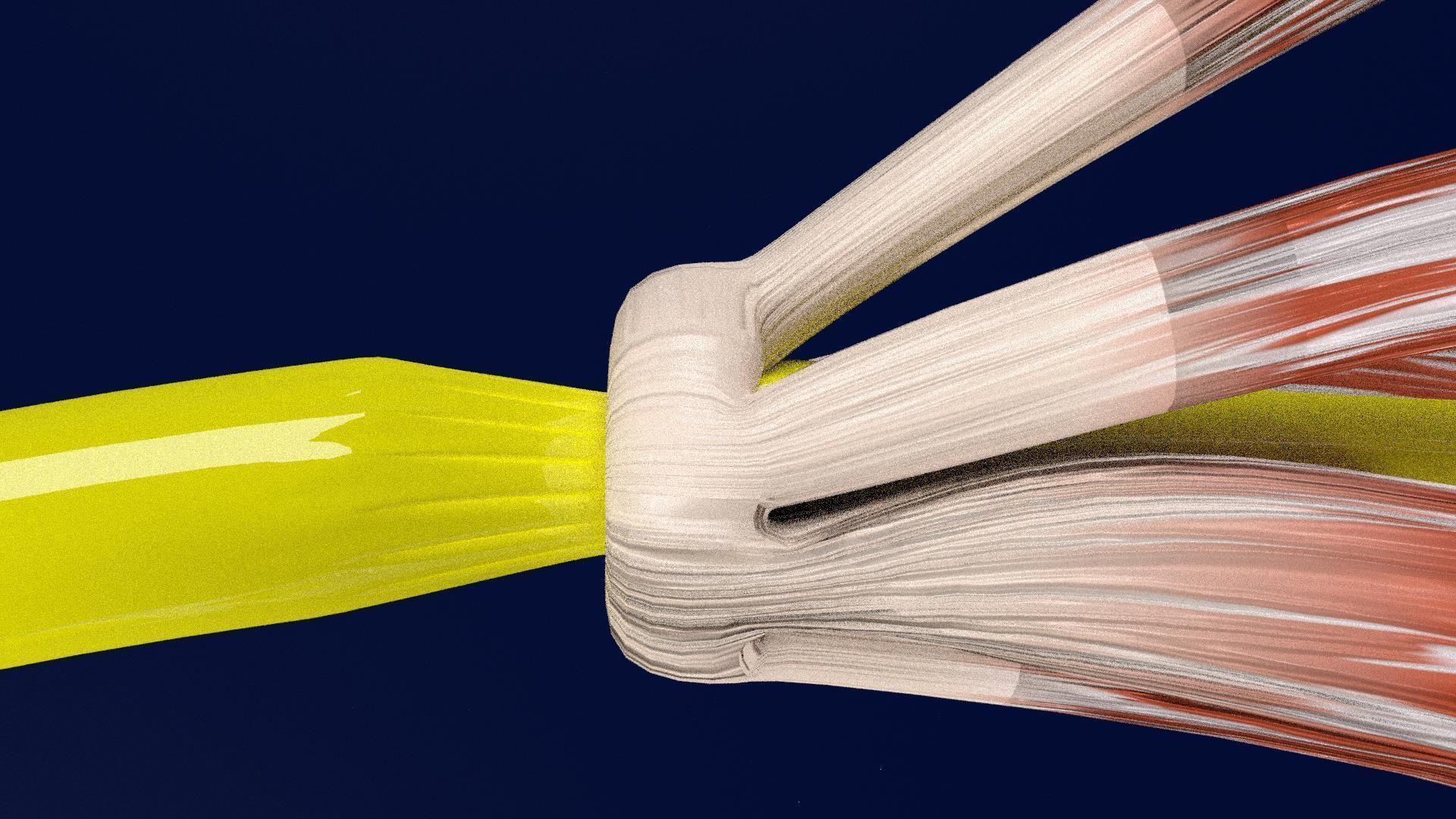 Thyroid eye lesions 3D model_19