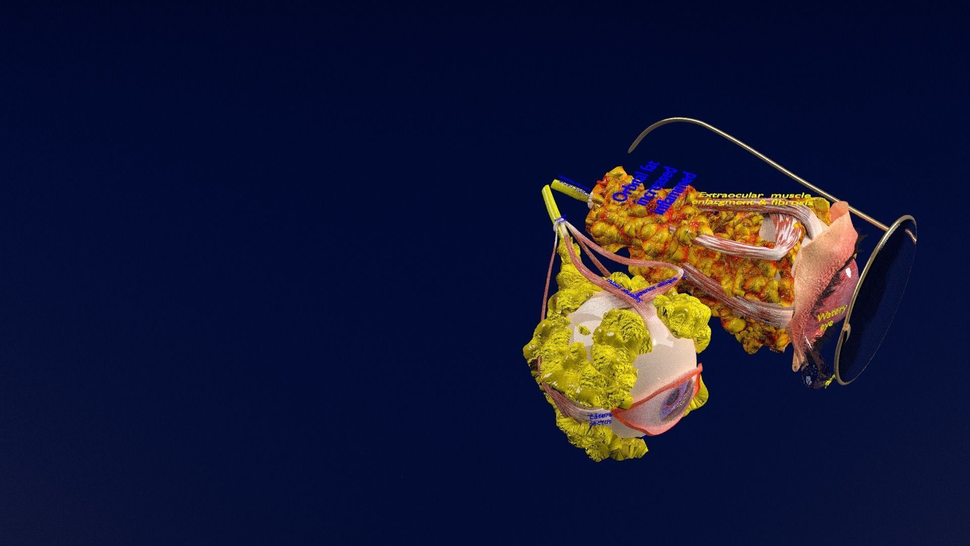 Thyroid eye lesions 3D model_50