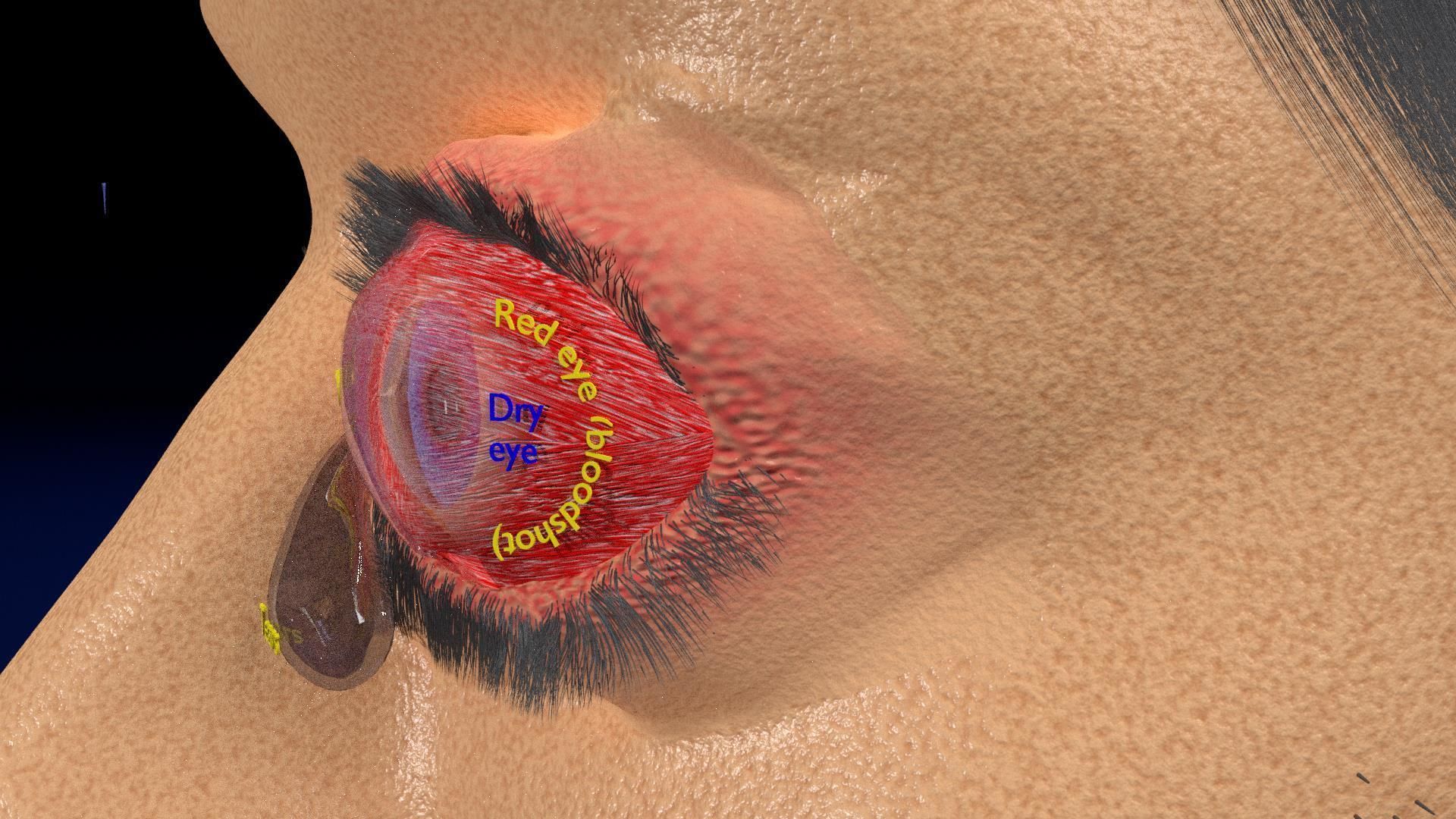 Thyroid eye lesions 3D model_8