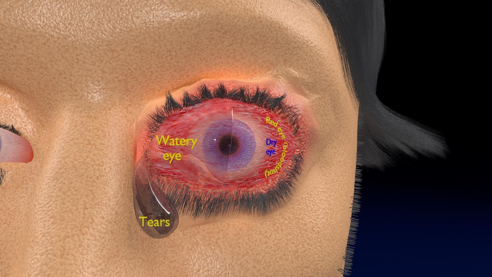 Thyroid eye lesions 3D model_6