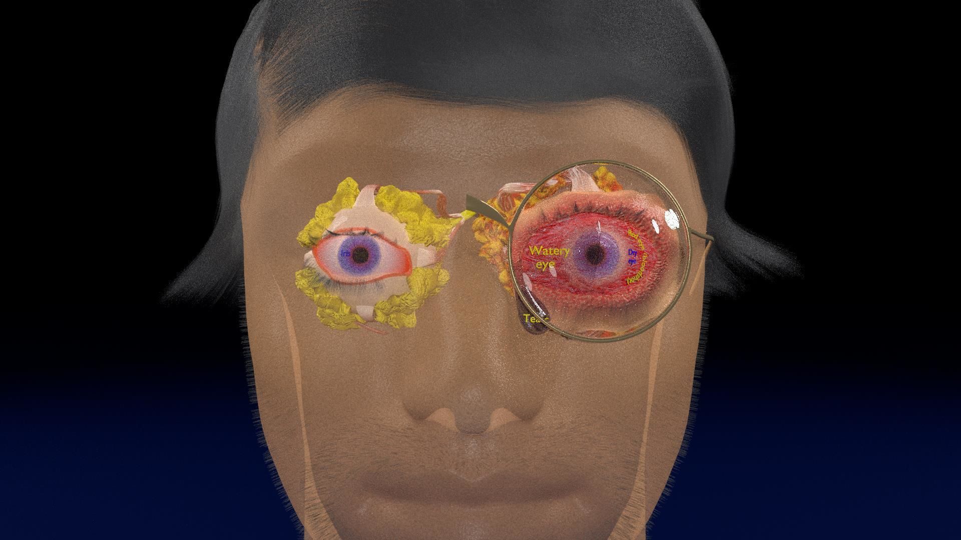 Thyroid eye lesions 3D model_21
