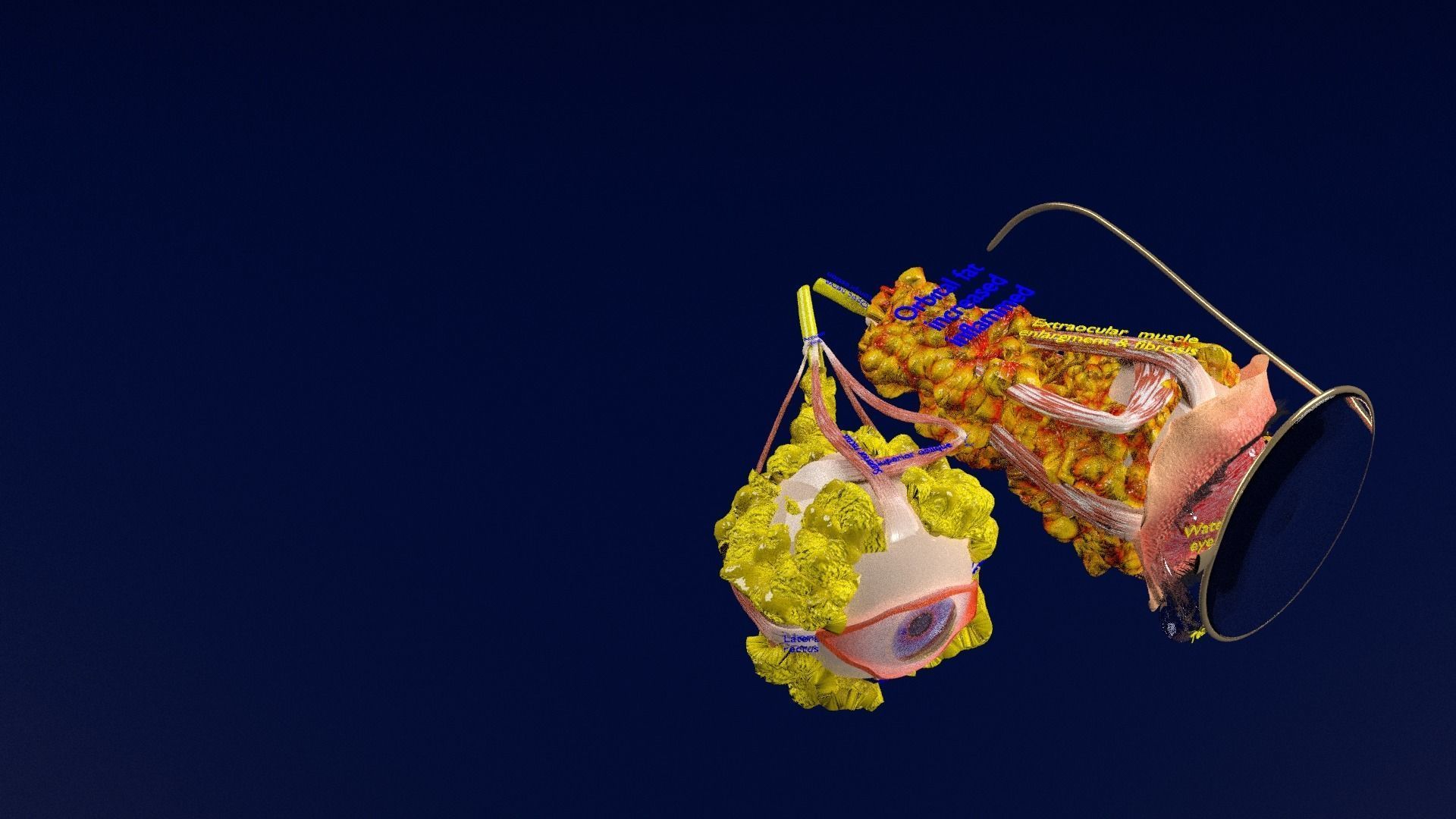 Thyroid eye lesions 3D model_54