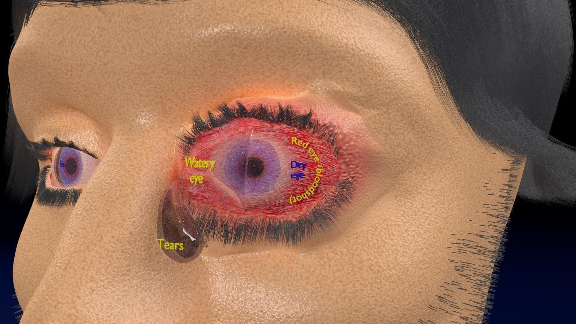 Thyroid eye lesions 3D model_7