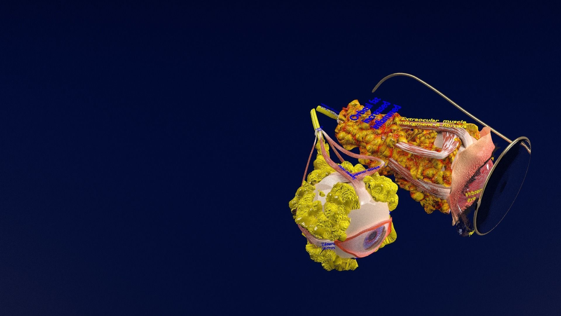 Thyroid eye lesions 3D model_34