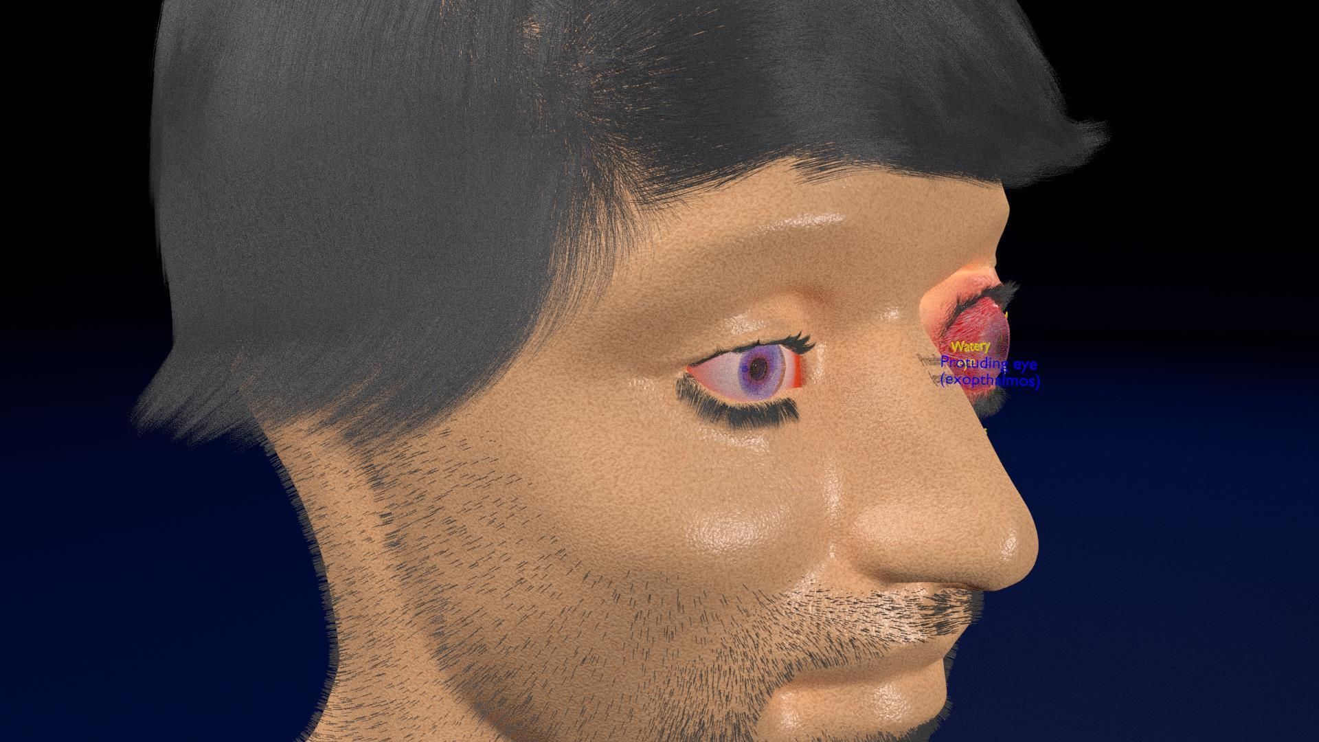 Thyroid eye lesions 3D model_3