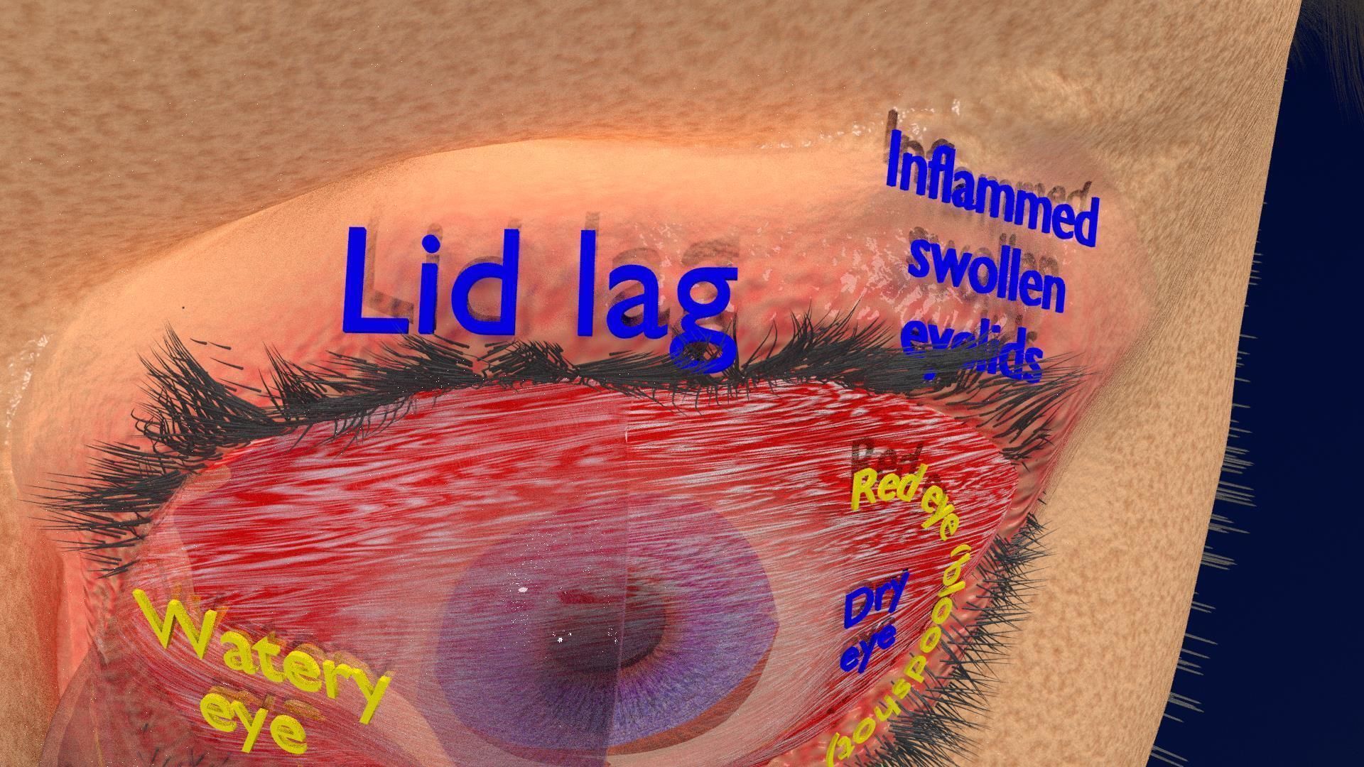 Thyroid eye lesions 3D model_9