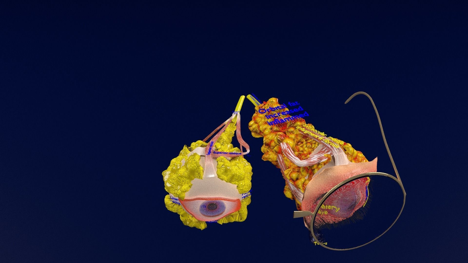 Thyroid eye lesions 3D model_33