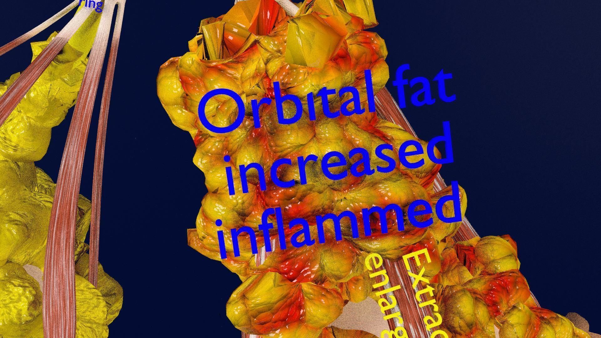 Thyroid eye lesions 3D model_16