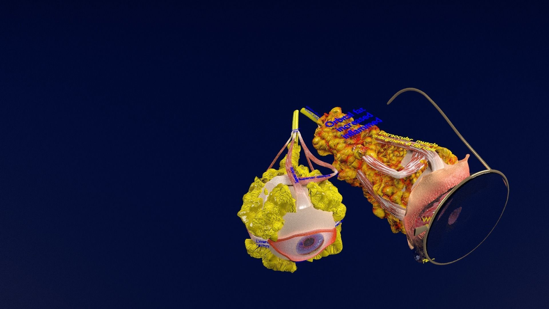 Thyroid eye lesions 3D model_46