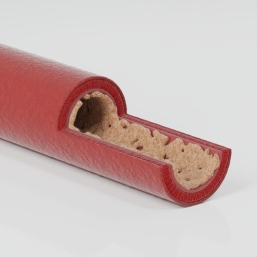 A vessel affected by atherosclerosis 3D model