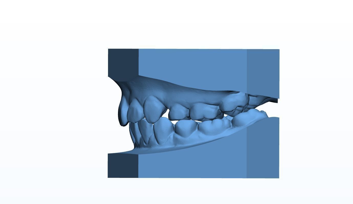 Teen Dental  Study Model 3D print model_6