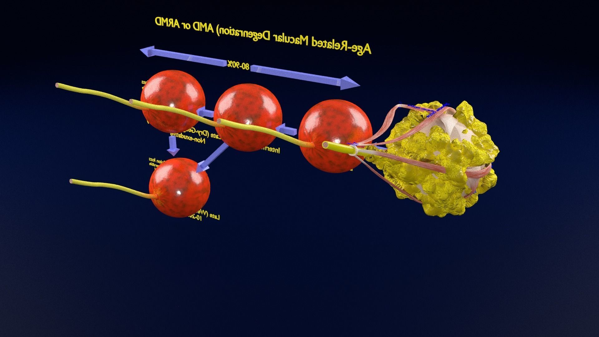 Age related macular degeneration AMD ARMD detailed labelled 3D model ...