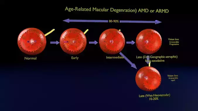 Age related macular degeneration AMD ARMD detailed labelled 