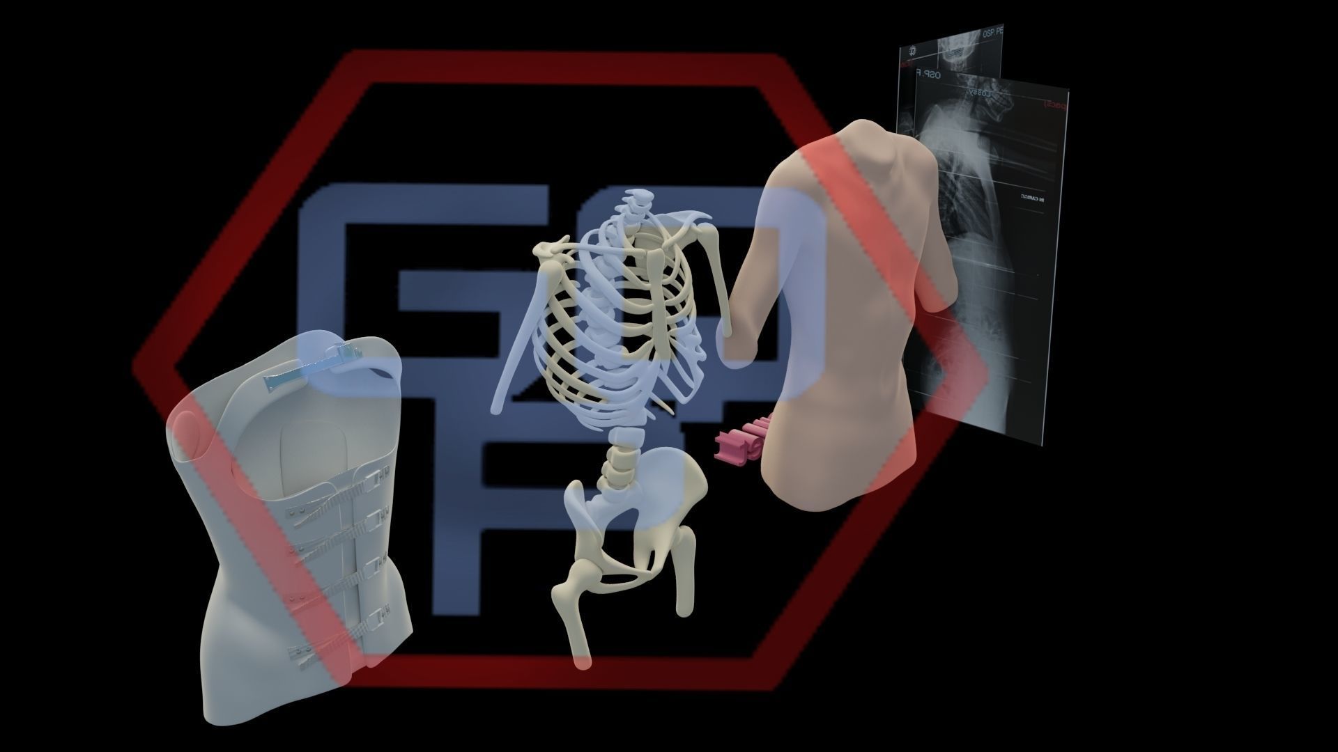 Orthopedic brace corset scoliosis animation Low-poly 3D model_11