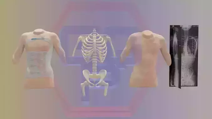 Orthopedic brace corset scoliosis animation Low-poly 3D model