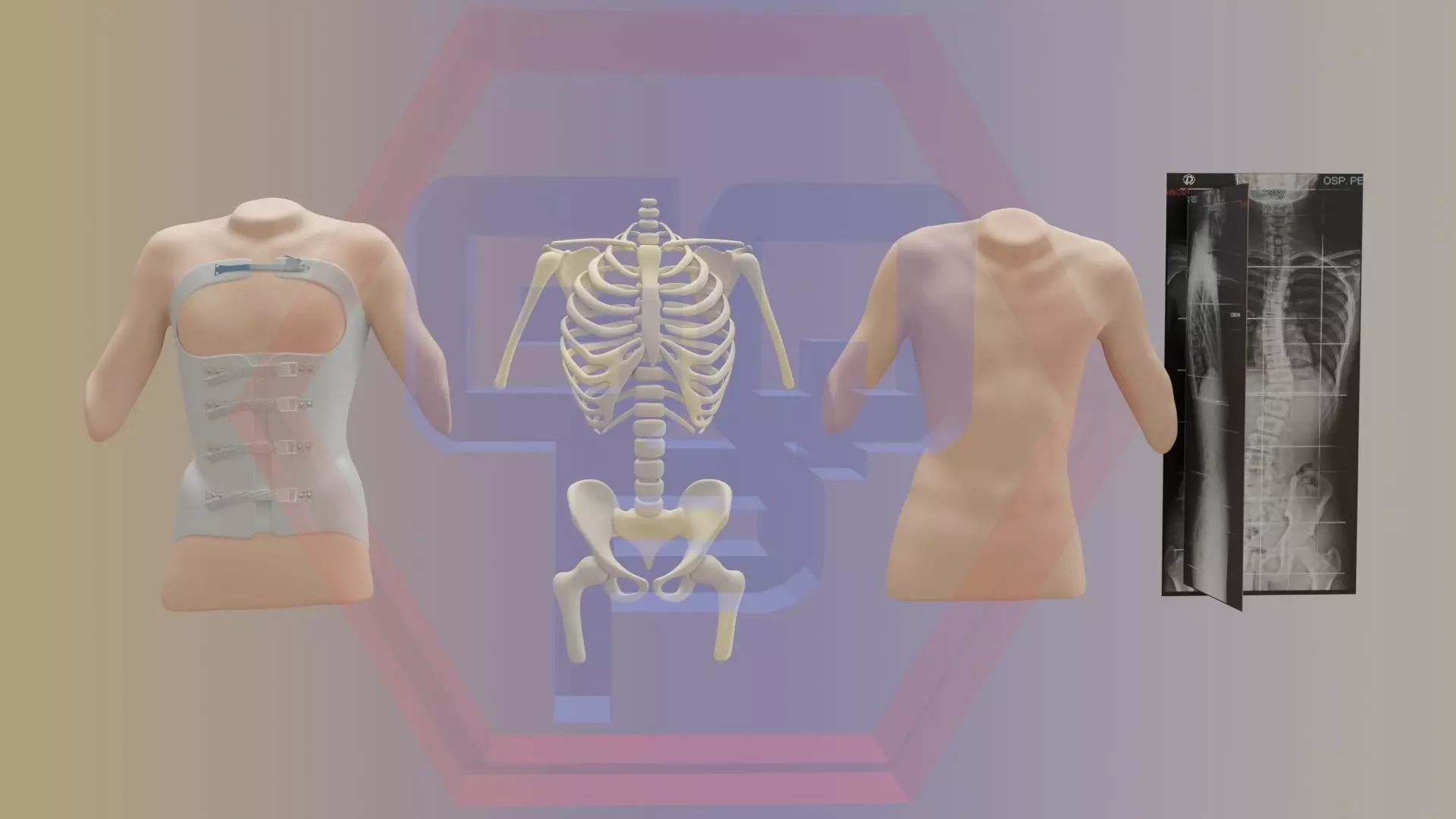 Orthopedic brace corset scoliosis animation Low-poly 3D model_0