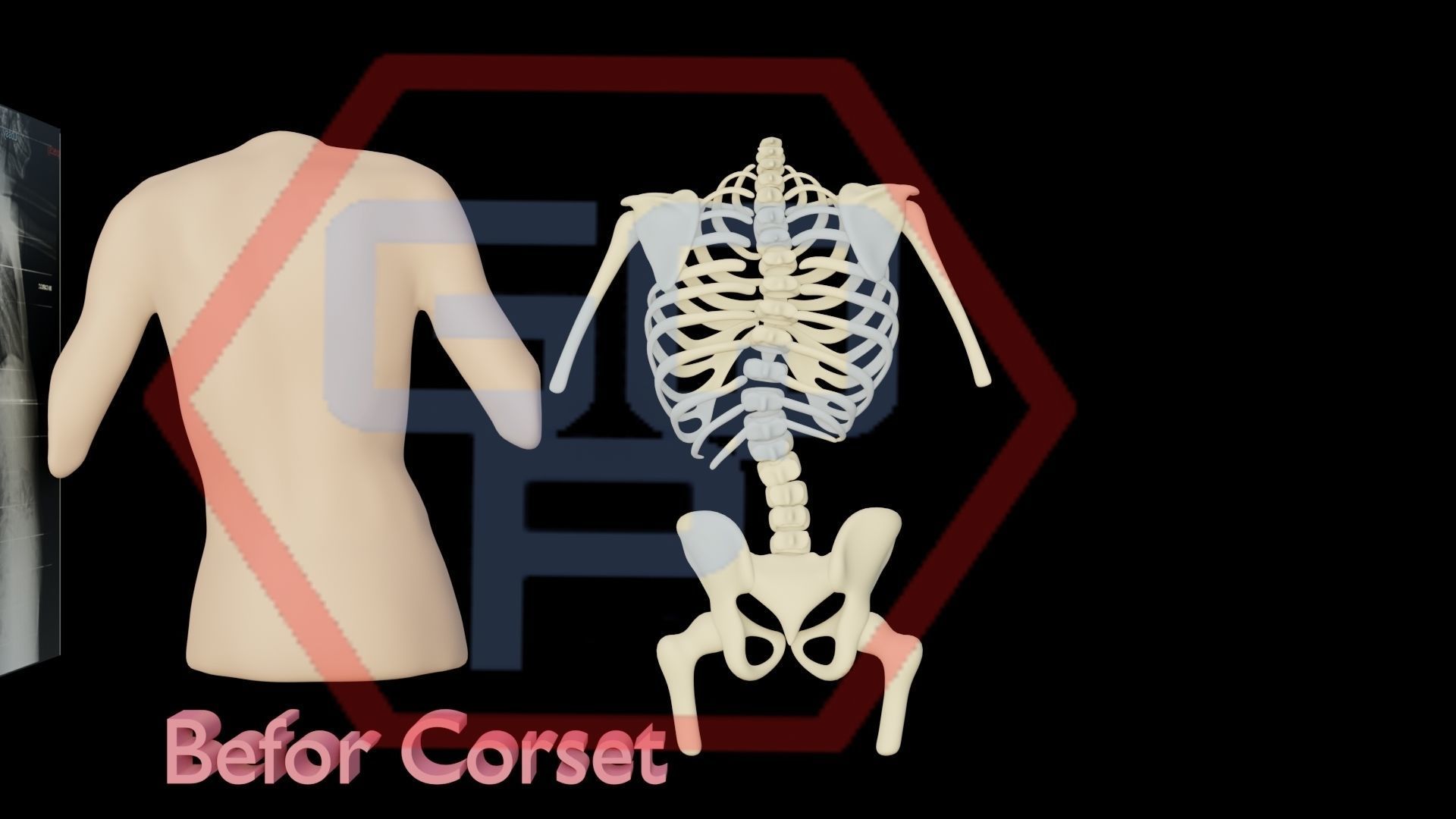 Orthopedic brace corset scoliosis animation Low-poly 3D model_7