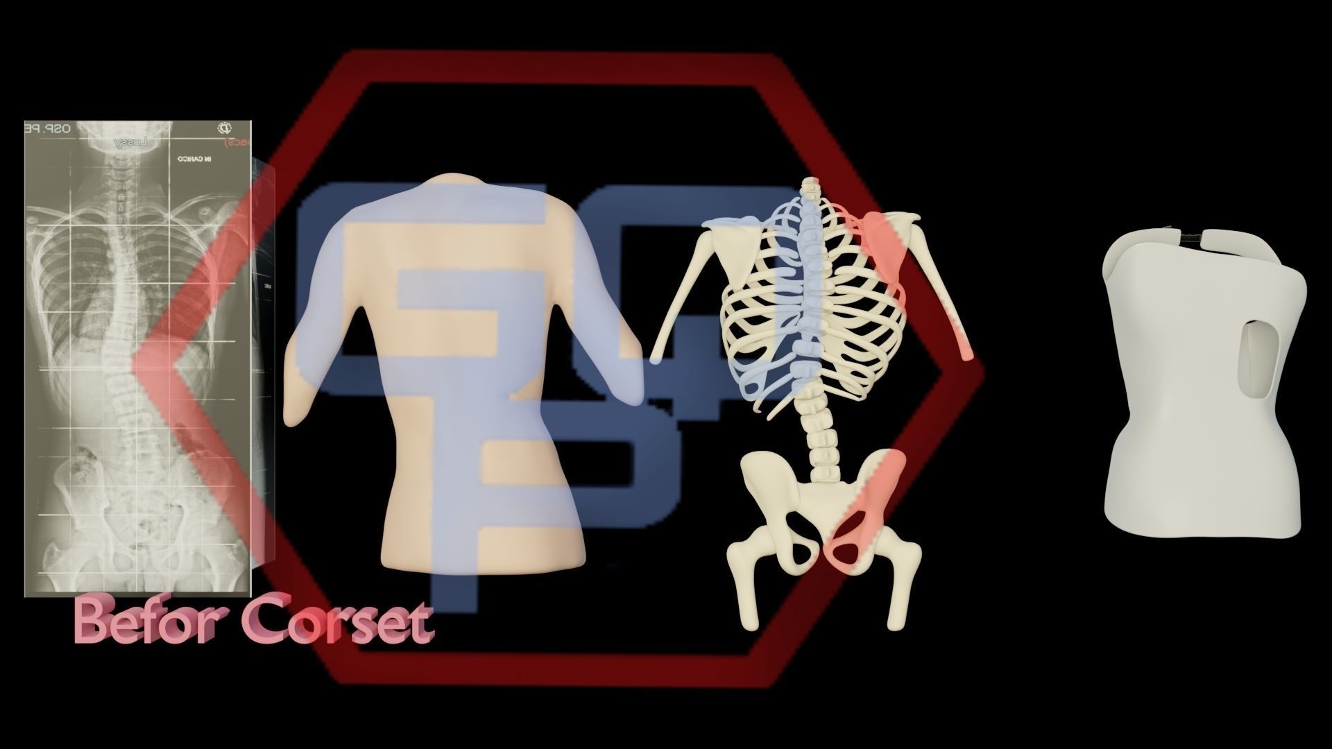Orthopedic brace corset scoliosis animation Low-poly 3D model_5