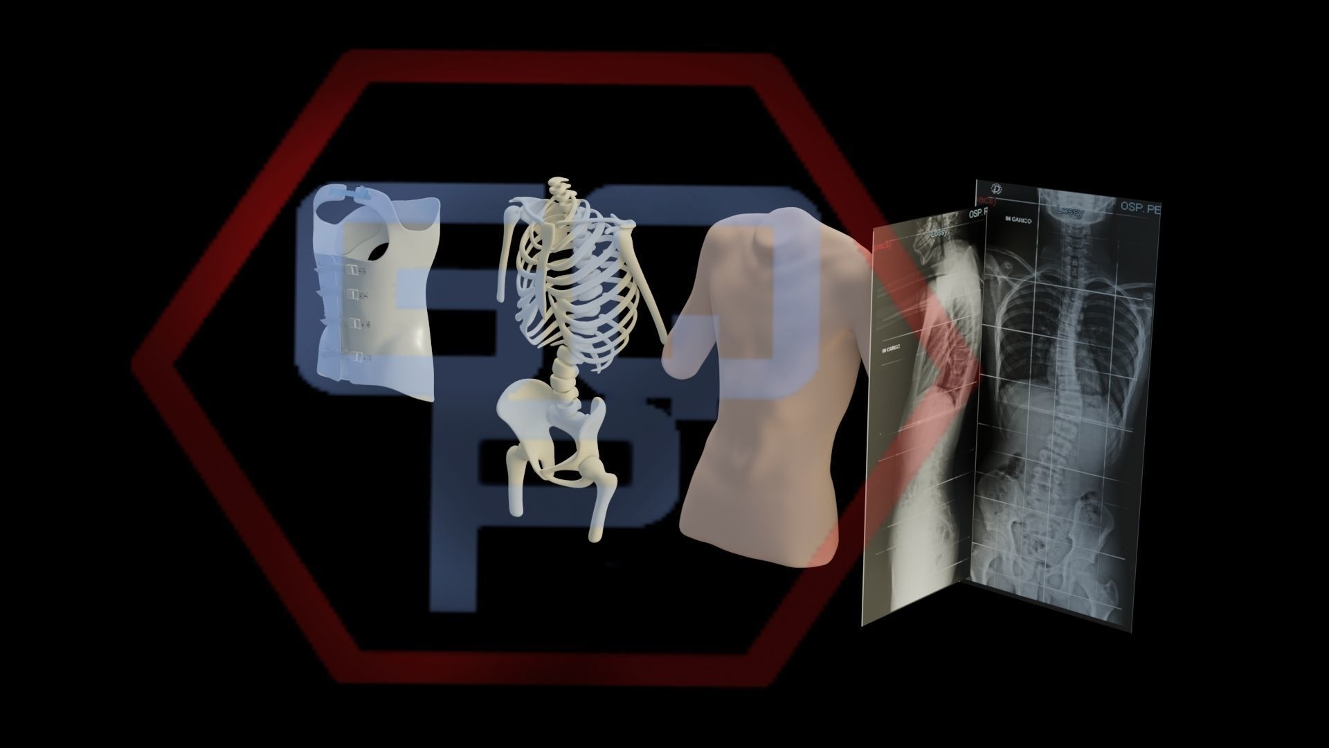 Orthopedic brace corset scoliosis animation Low-poly 3D model_10