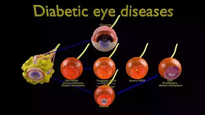 Diabetic eye diseases